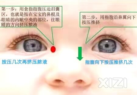 婴儿泪腺堵塞怎么办