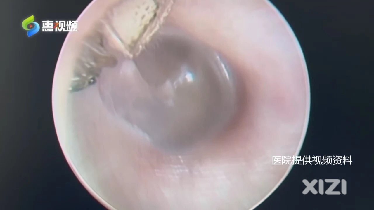 蜘蛛！活的！进耳朵了！怎么办？医生：这件事千万不做→
