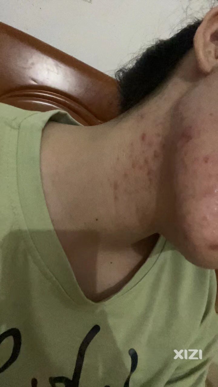 痤疮真的很难治好吗？