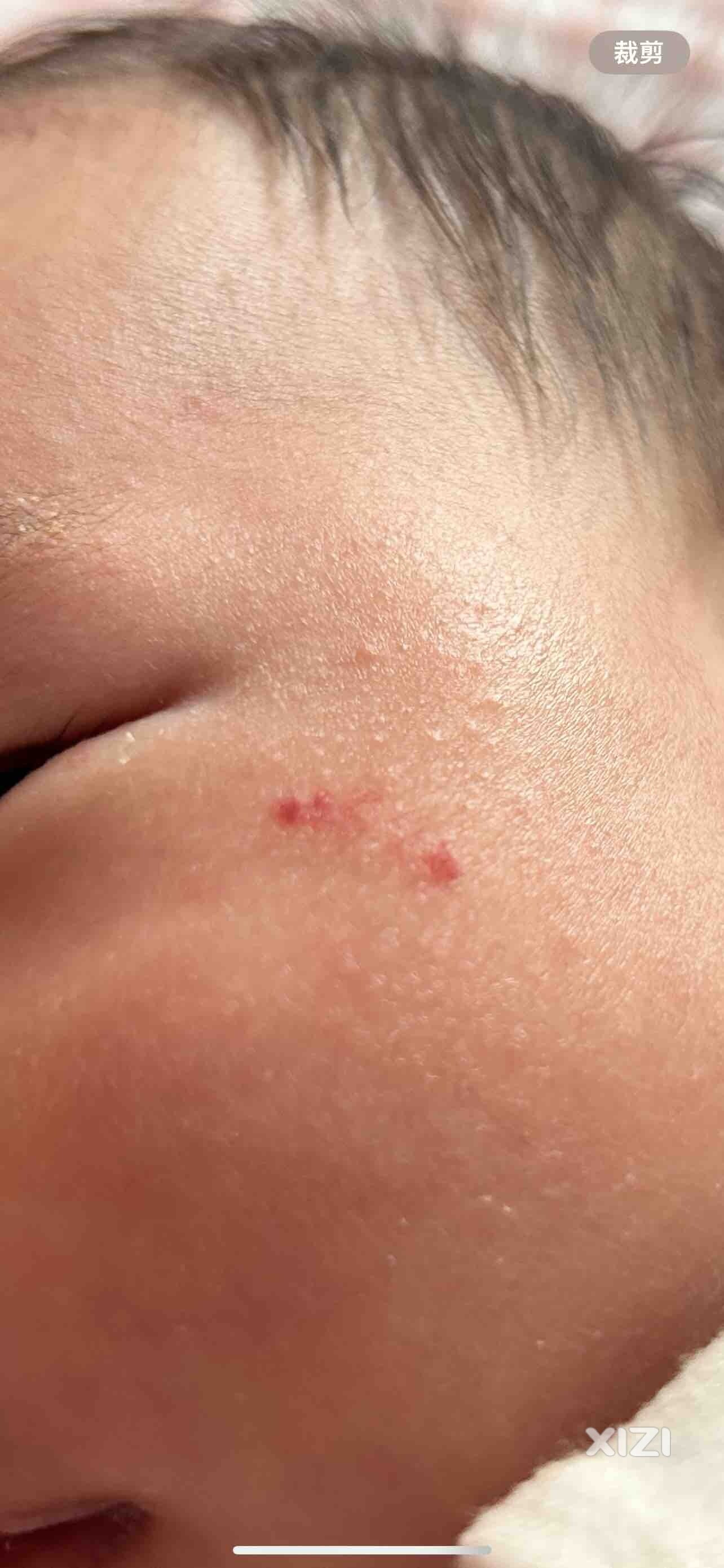 小孩血管瘤问题