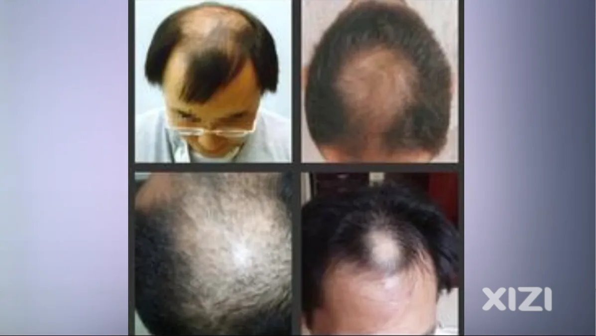 2.5亿人脱发！90后成主力军！为什么？惠州有医生这么说→