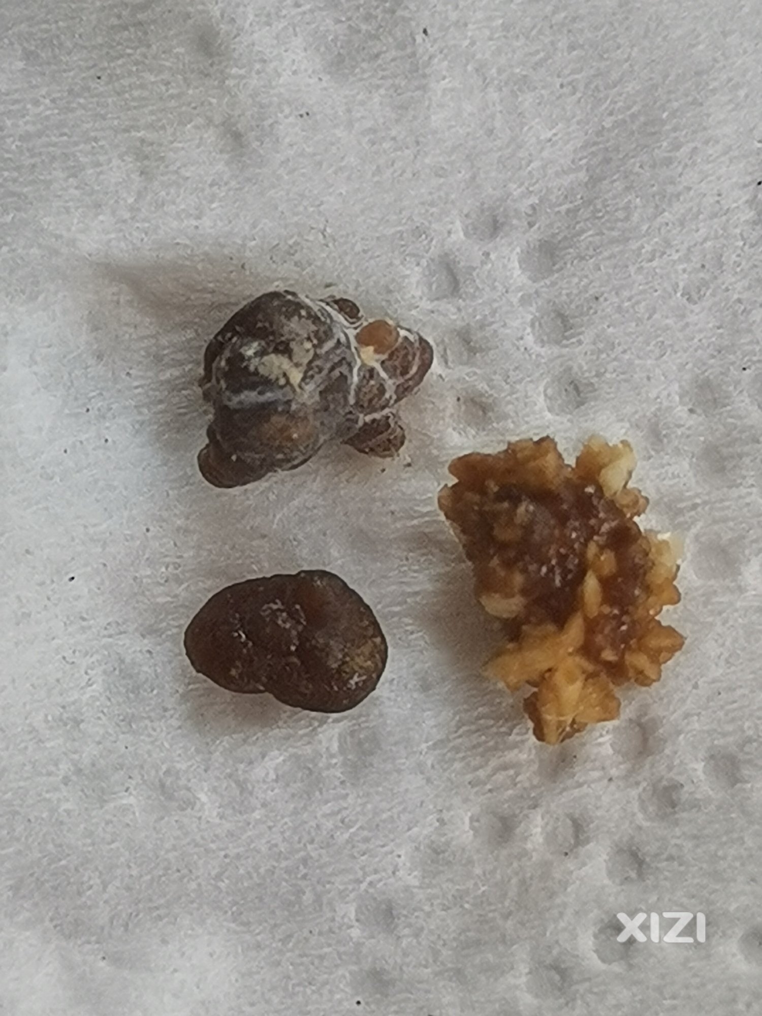排出的肾结石为何像貌迥异？