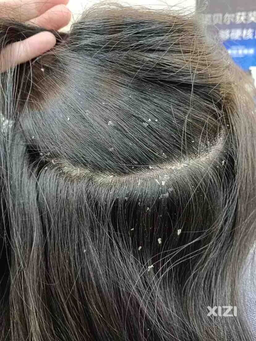头皮屑
