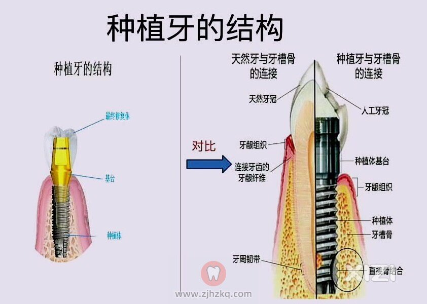 求专业口腔医院或者专科诊所，因为种植大牙板