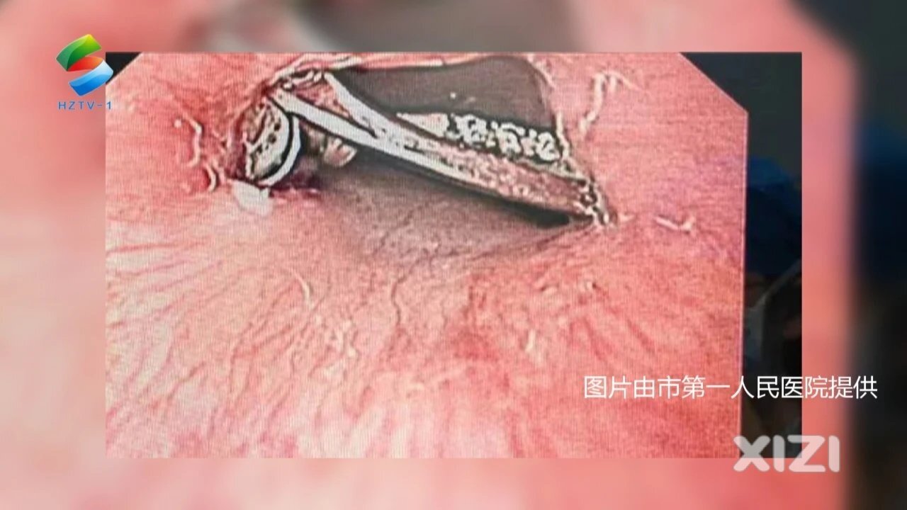 “消失”的钻戒竟被医生找到了？